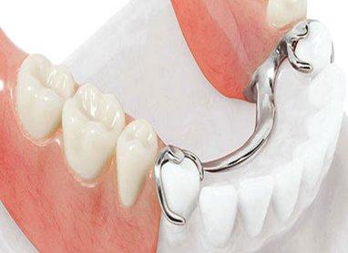 Beste kunstgebit in 2026