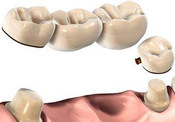 Beste kunstgebit in 2026